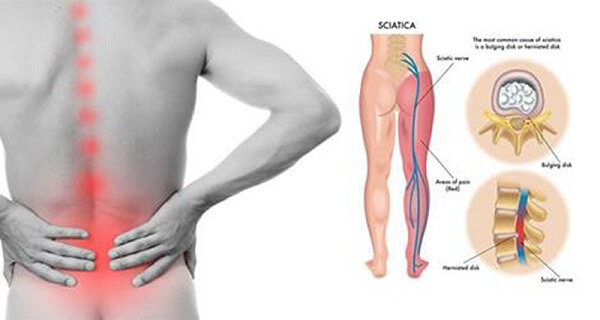Bị đau lưng dưới gần mông là bệnh gì?