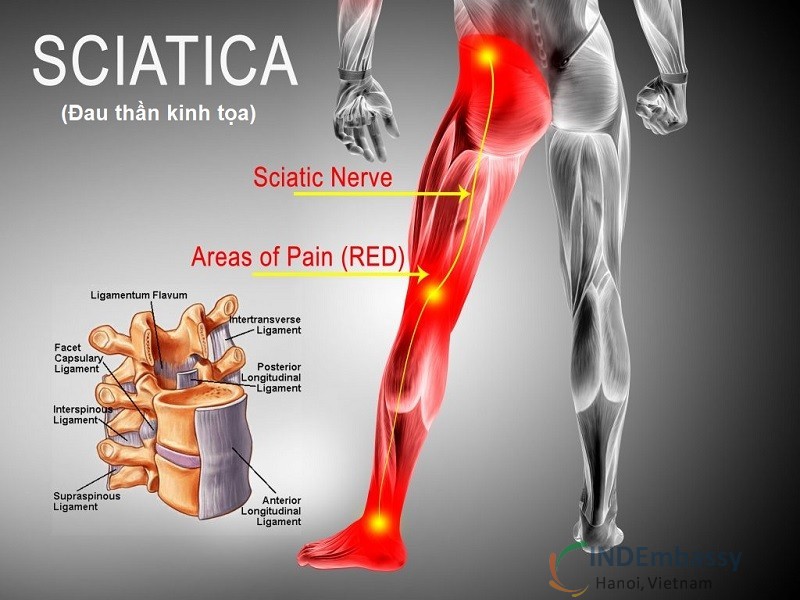 Đau dây thần kinh tọa và cách bấm huyệt giúp chữa khỏi