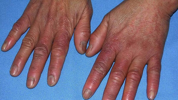 Đầu ngón tay bị sưng nhức có nguy hiểm cho sức khỏe không ?