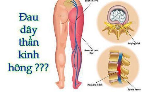 Giảm đau thần kinh tọa ngay lập tức không cần thuốc